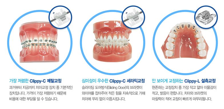 돌출입 치아교정, 수술없이 정상교합으로 관련 이미지 5