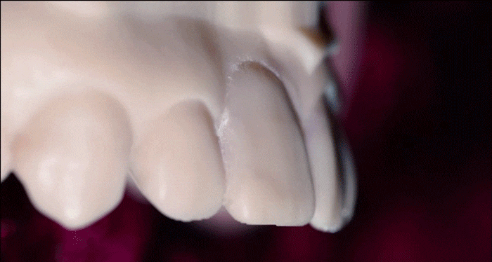 What to Check Before Deciding on Dental Laminates image 15