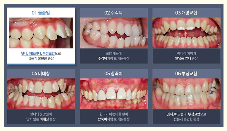 육지담 양악 달라진 비결 부정교합 치아교정에서 찾자 관련 이미지 4