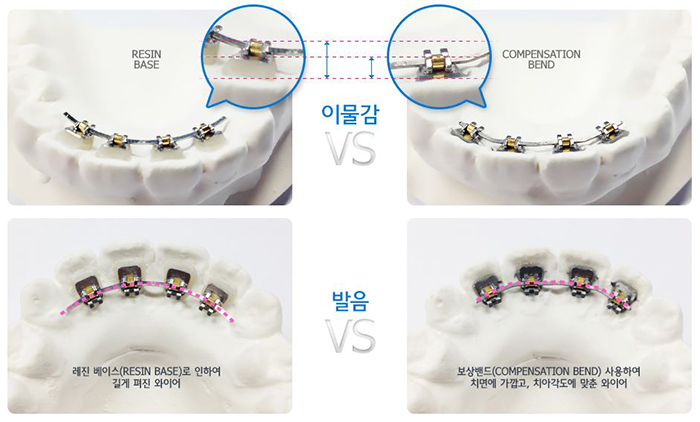 안보이는교정 아직도 감추고 다닐 걱정하세요? 관련 이미지 4