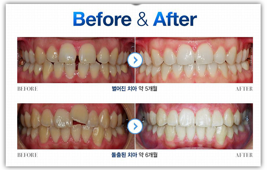 투명교정후기 정보 여기서봐바!!! 관련 이미지 4