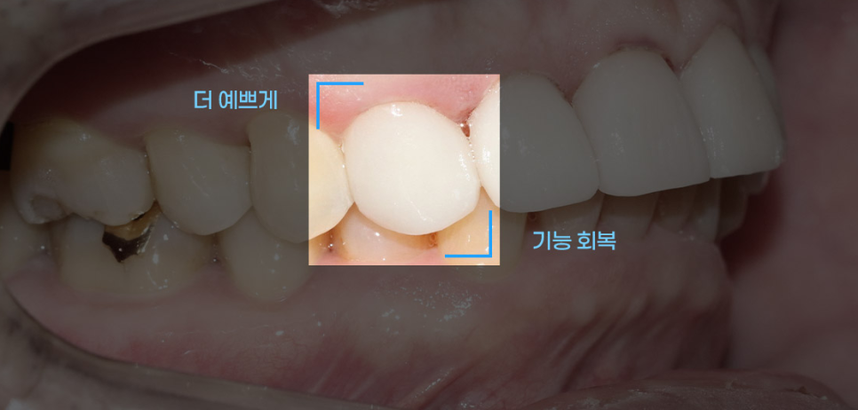 라미네이트 치료를 위한 정보 관련 이미지 23