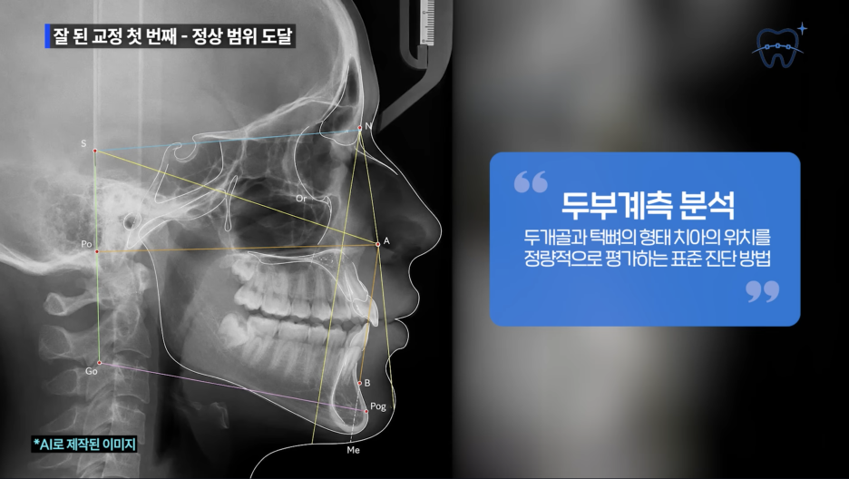 How to Avoid a Failed Invisalign Treatment at a Sinsa-dong Invisalign Dental Clinic image 5