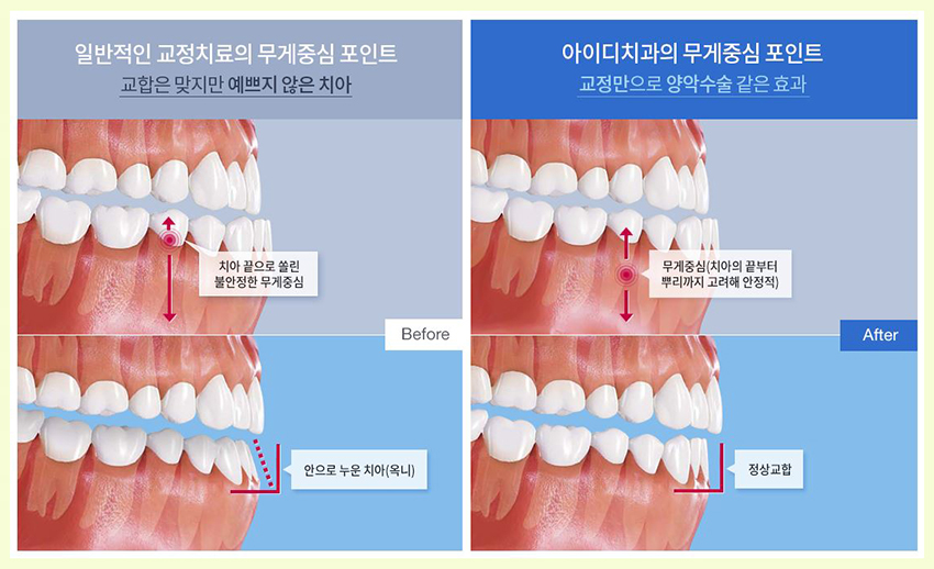 청소년치아교정 사춘기 치아고민 조기에 바로잡자 관련 이미지 5