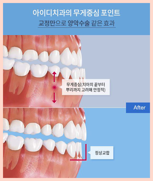 돌출입치아교정비용 찾아낸 반전매력 양악교정 믿을만해 관련 이미지 2