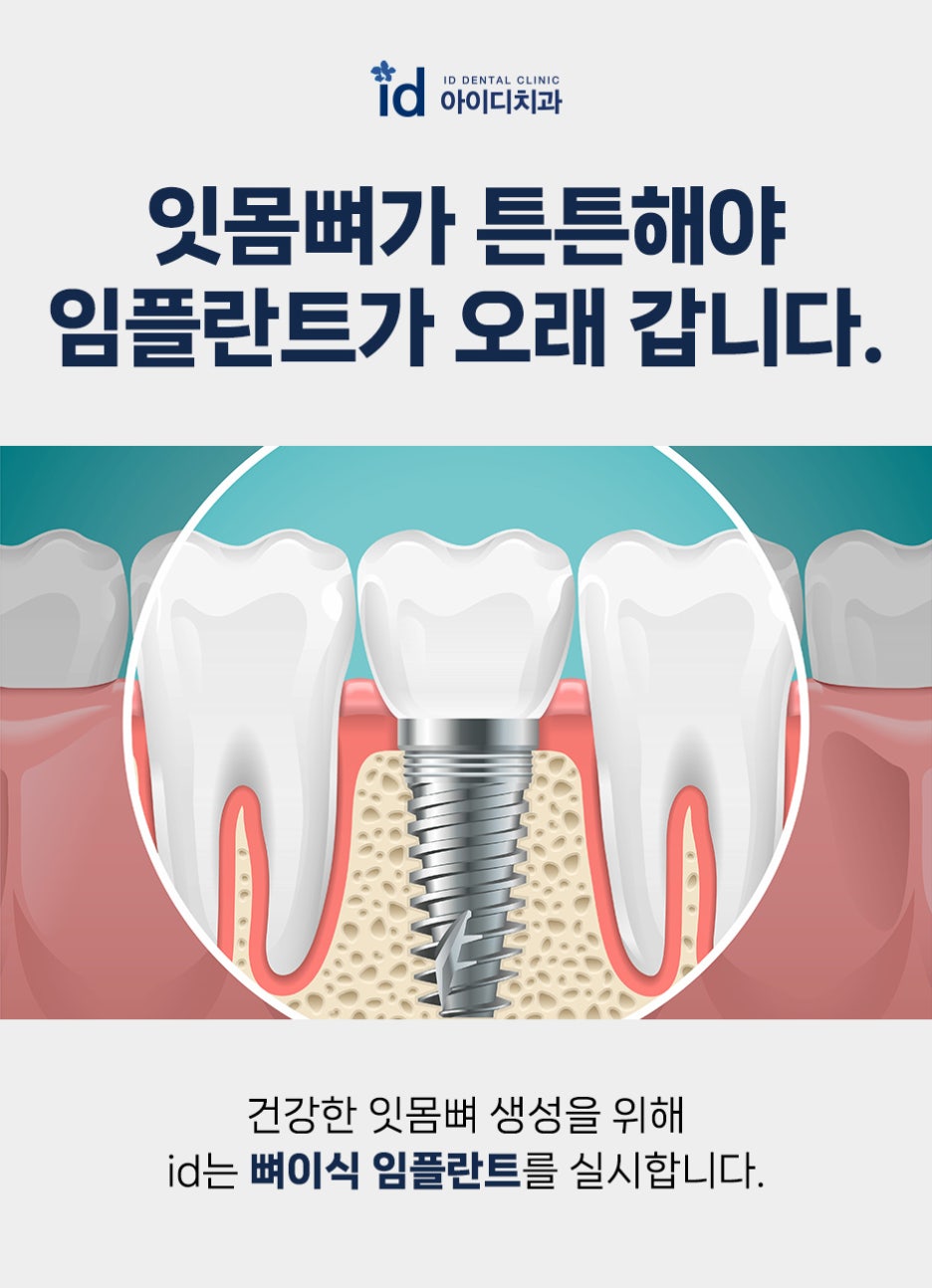 Recommended Place for Dental Implants That Reduces Fear image 14