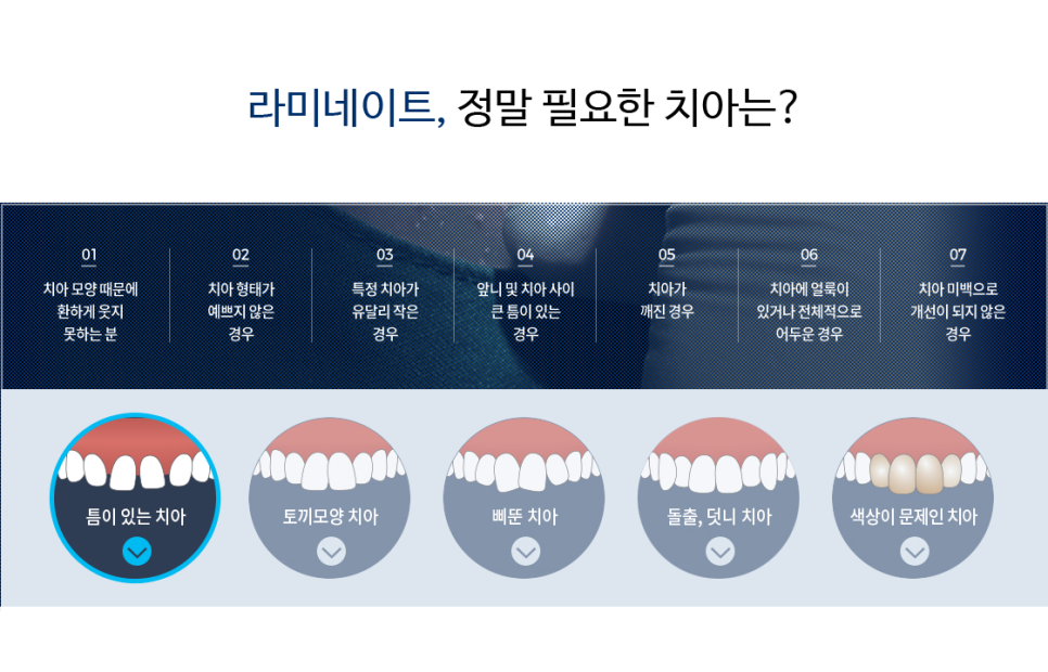 라미네이트, 시술 전 체크해야 할 것은? 관련 이미지 4