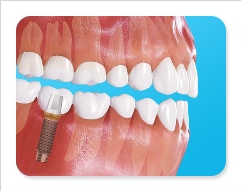 제2의치아 임플란트의 종류 관련 이미지 4