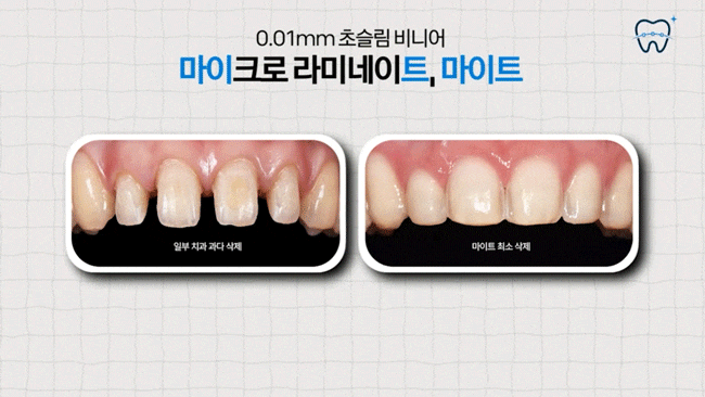 How to Make a Regret-Free Choice When Looking for a Recommended One-Day Laminate Dentist Near Nonhyeon Station image 14