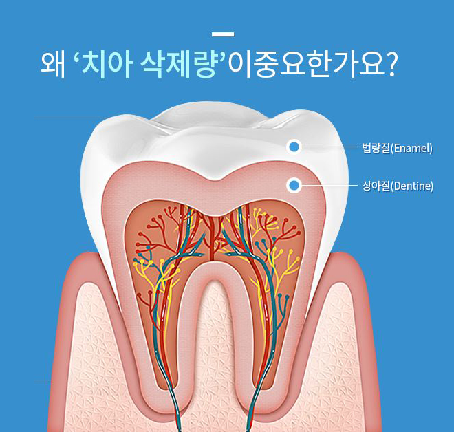 무삭제라미네이트 치아속까지 생각한다면 0.1이지 관련 이미지 2