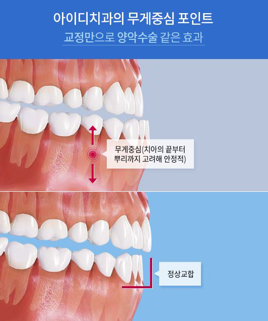 어린이 부정교합 놓치지 않도록 조기부터 시작해야해 관련 이미지 6