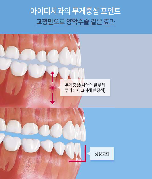 돌출입 치아교정, 수술없이 정상교합으로 관련 이미지 6