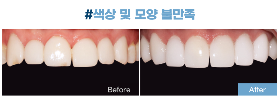 라미네이트 치료를 위한 정보 관련 이미지 24
