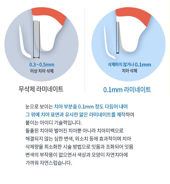 무삭제라미네이트 치아속까지 생각한다면 0.1이지 관련 이미지 4