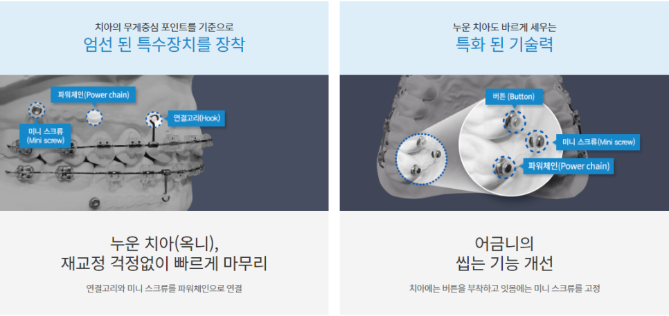 돌출입치아교정, 수술 부담없이 개선가능 관련 이미지 7
