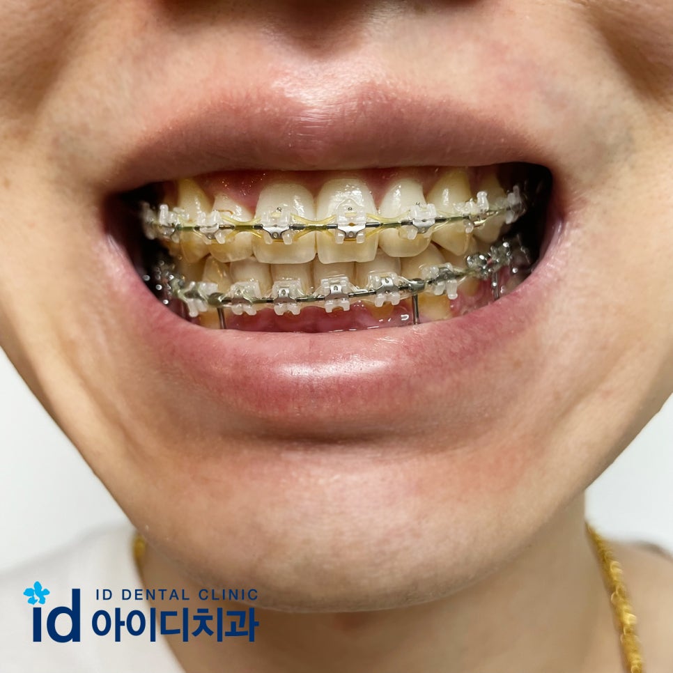 클리피씨교정 안되는 경우가 있을까요? 관련 이미지 1