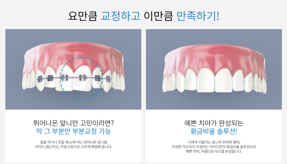 치아 부분교정 진행 과정과 적합 케이스에 대한 진실! 관련 이미지 6