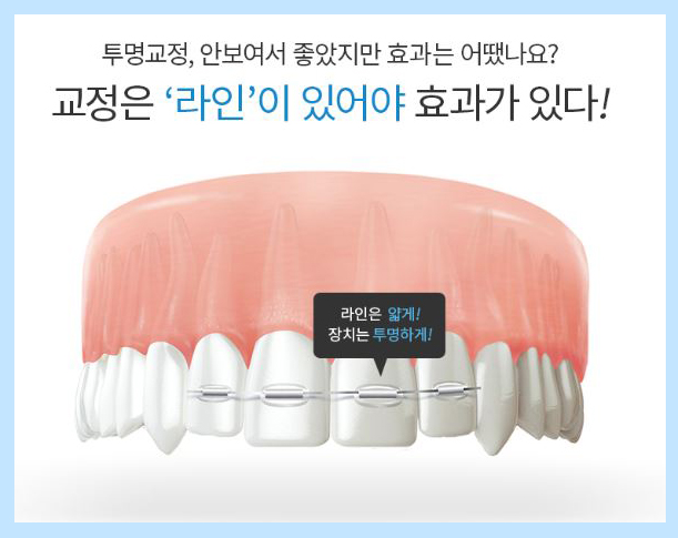 투명교정 부작용 해결을 도와줄 id 투명라인교정 관련 이미지 4
