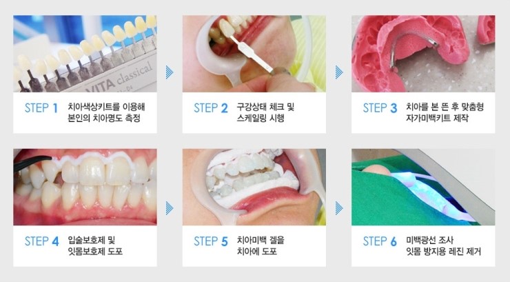 치아미백후기 치아색부터 모양까지 올인원 관련 이미지 3