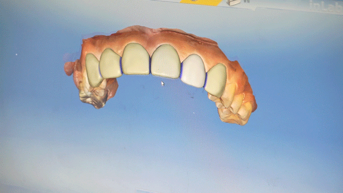 What to Check Before Deciding on Dental Laminates image 6