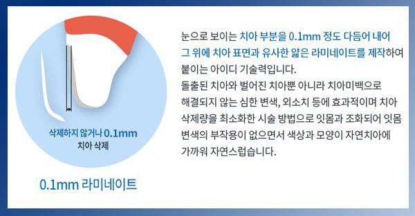 영점일 라미네이트 비용 만큼 중요한건 치아 삭제량! 관련 이미지 2