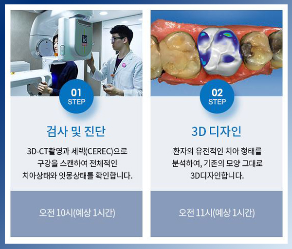영점일 라미네이트 비용 만큼 중요한건 치아 삭제량! 관련 이미지 4