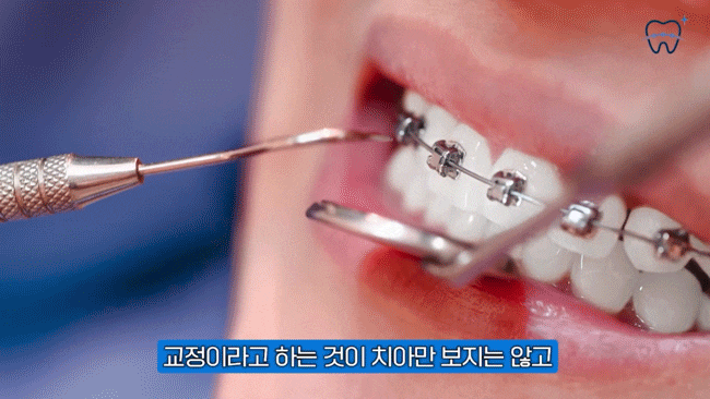Gangnam Sinsa-dong Clear Aligner Dental Clinic: What Are the Criteria for Successful Orthodontic Treatment? image 3