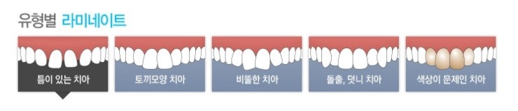 치아성형, 최적의 시술은 무엇? 관련 이미지 4
