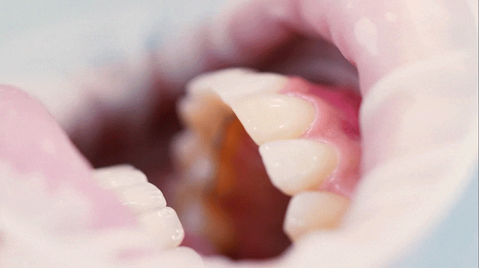 What to Check Before Deciding on Dental Laminates image 2