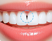 Gum Filler: When the Empty Space Between Teeth Becomes a Concern image 3