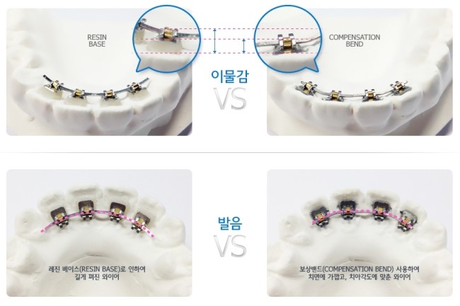 치아교정, 가지런한 치아배열을 위한 선택 관련 이미지 4