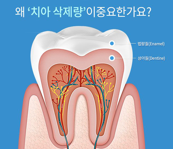 앞니라미네이트비용 빈틈없이 내것같은 앞니완성 관련 이미지 3