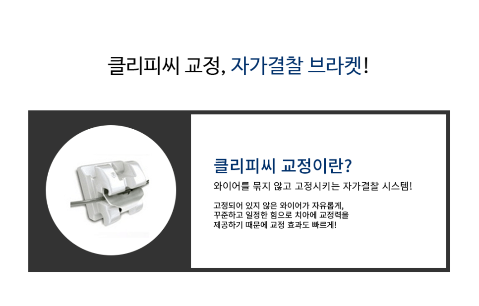 치아교정, 종류와 선택의 기준은? 관련 이미지 6