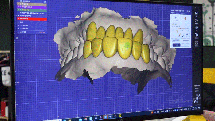 What Should You Look At When Choosing No-Prep Laminate Veneers? image 12