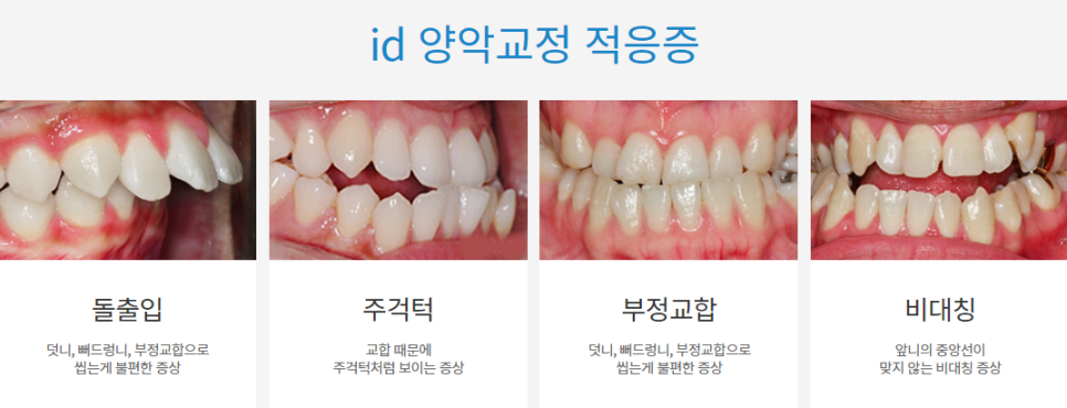 돌출입치아교정, 수술 부담없이 개선가능 관련 이미지 4