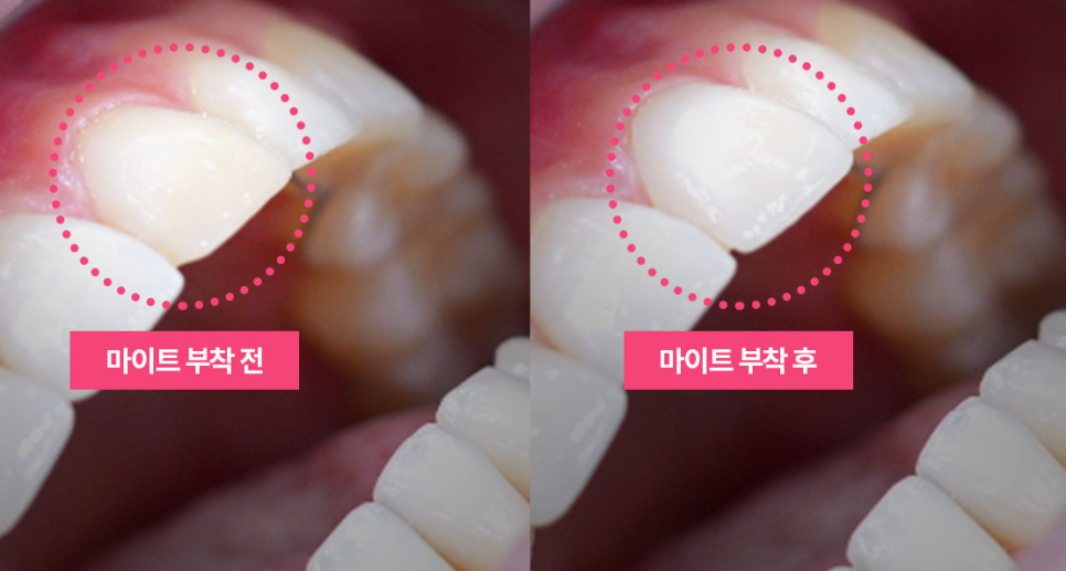 라미네이트 치료를 위한 정보 관련 이미지 12