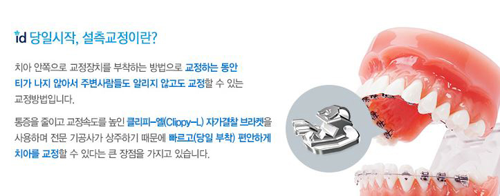 설측교정후기 보일 걱정없이 비밀스럽게 관련 이미지 2