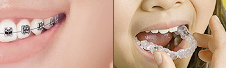Things Good to Know Before Getting Orthodontic Treatment! image 3