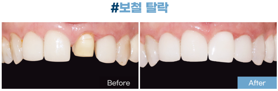 라미네이트 치료를 위한 정보 관련 이미지 25