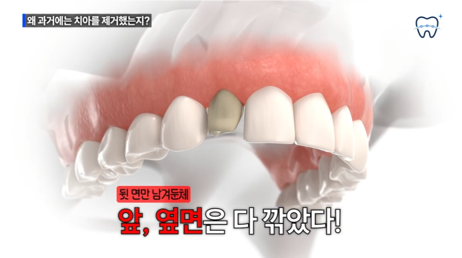 강남무삭제라미네이트 자연 치아 보존까지 생각하는 곳 관련 이미지 6
