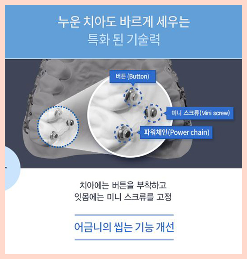 돌출입치아교정비용 찾아낸 반전매력 양악교정 믿을만해 관련 이미지 3