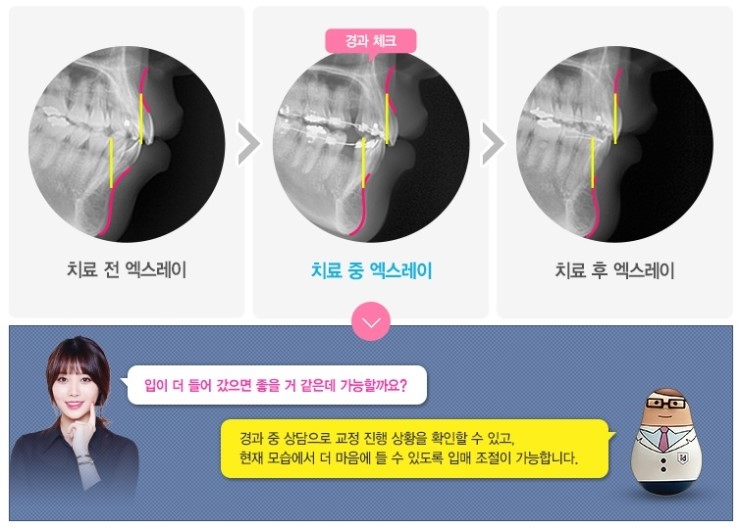 돌출입교정기간 돌출입도 합죽이도 치료가능 관련 이미지 2