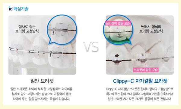 앞니교정후기 어떤 앞니고민도 다양하게 해결 관련 이미지 5
