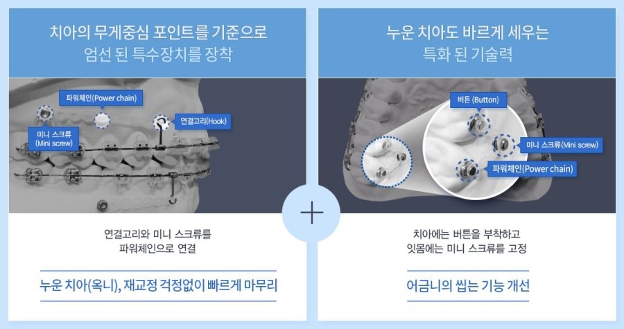 돌출입교정가격 입툭튀라고 수술하란법 없지! 관련 이미지 3