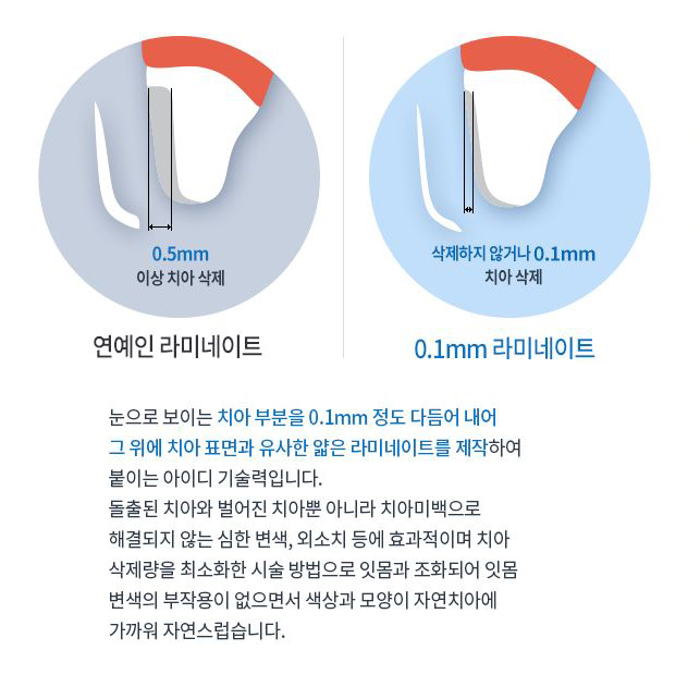 앞니라미네이트비용 빈틈없이 내것같은 앞니완성 관련 이미지 2