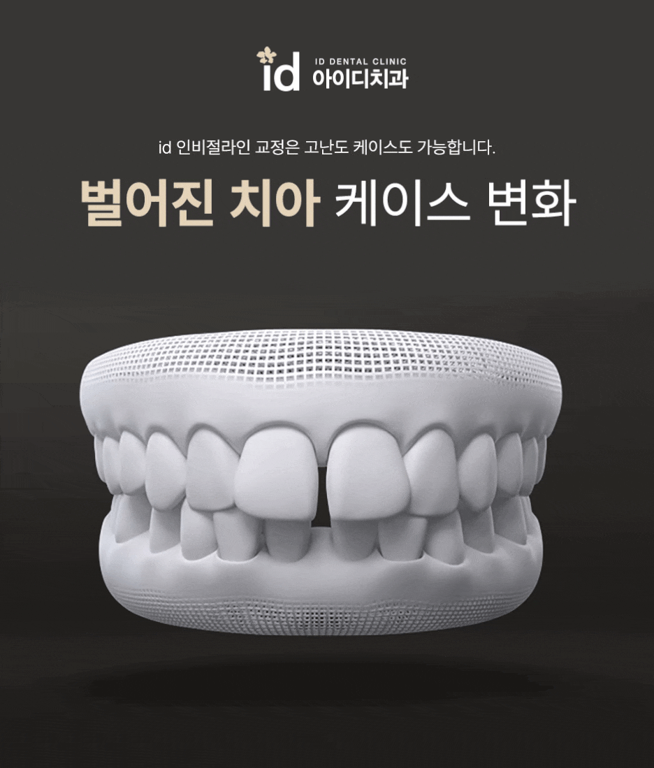 앞니벌어짐교정 눈에 안 띄게 교정하고 싶다면? 관련 이미지 2