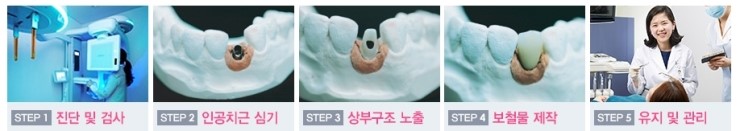 제2의치아 임플란트의 종류 관련 이미지 8