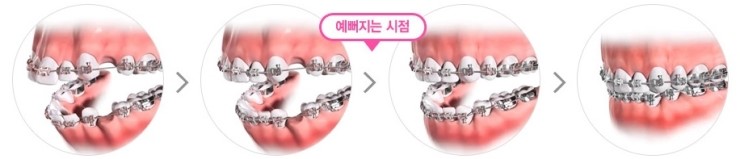 돌출입교정 어디까지 알고 있나요? 관련 이미지 6