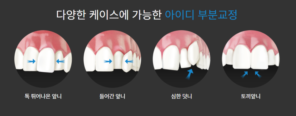 치아 부분교정 진행 과정과 적합 케이스에 대한 진실! 관련 이미지 4