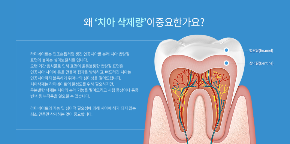 라미네이트, 시술 전 체크해야 할 것은? 관련 이미지 3